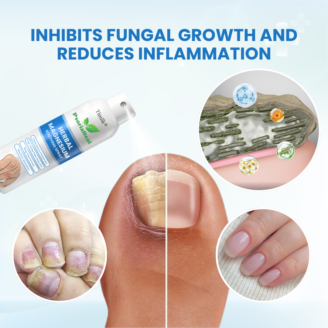 Timilk® PsoriaHeal Herbal Magnesium Soothing Spray⭐