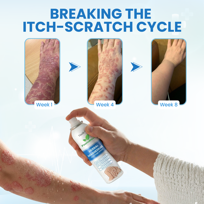 Timilk® PsoriaHeal Herbal Magnesium Soothing Spray⭐
