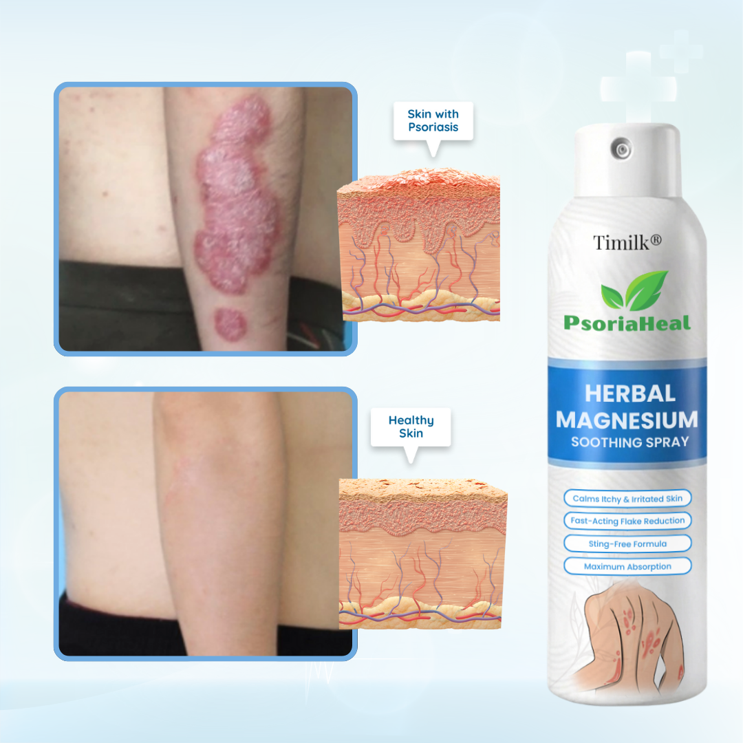 Timilk® PsoriaHeal Herbal Magnesium Soothing Spray⭐