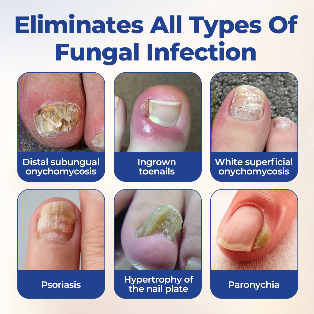 Timilk® FungiBee Advanced Nail Repair Solution